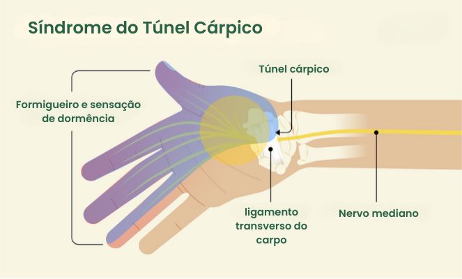 Sindrome do tunel do carpo fotos, imagens