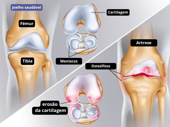 Artrose no Joelho