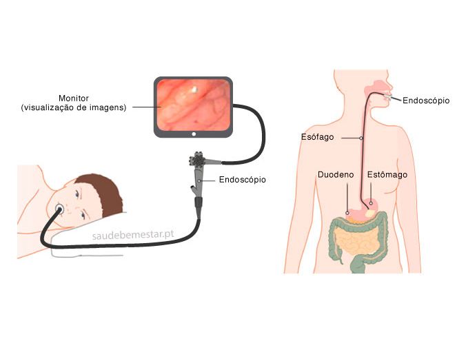 Fotos de Endoscopia digestiva alta