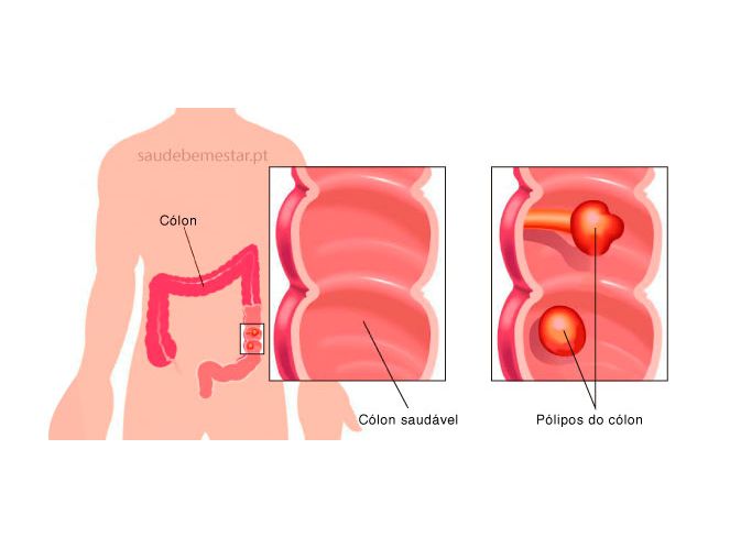 Fotos de pólipos intestinais