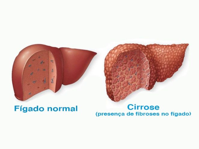 imagens de  Cirrose