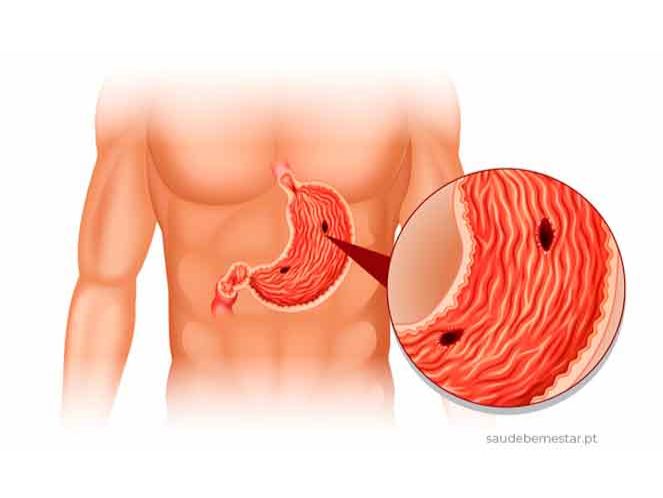 imagens de Úlcera no estômago