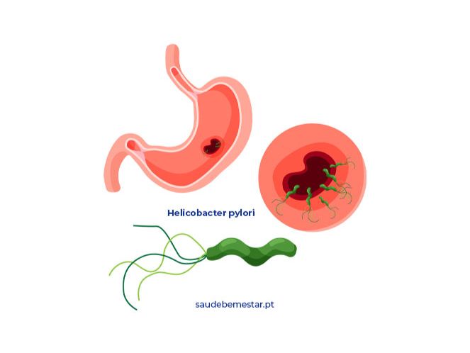 Helicobacter pylori