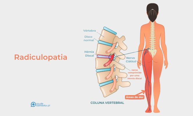 Radiculopatia