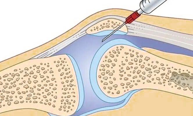 Derrame Articular